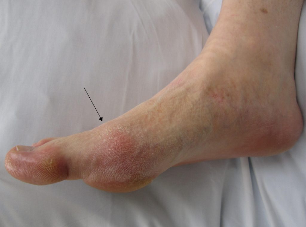 Gout: Causes and also Diagnosis