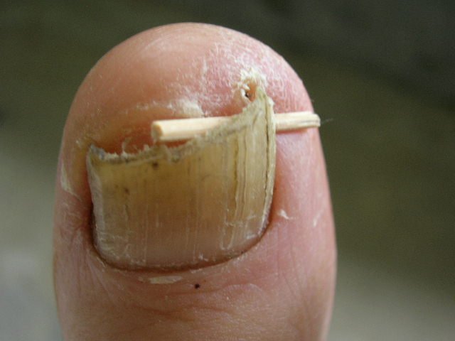 What is an ingrown toenail?