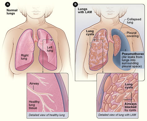 Lung Health