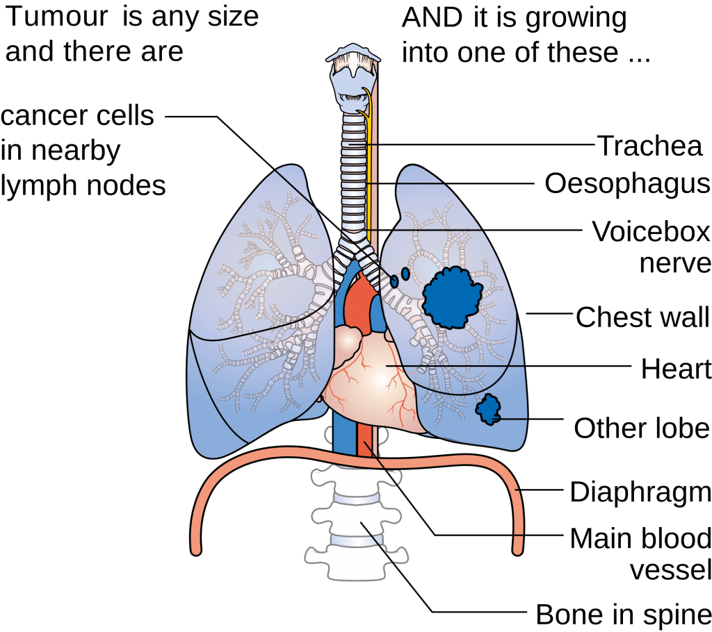 What are some of the tests done in lung cancer?