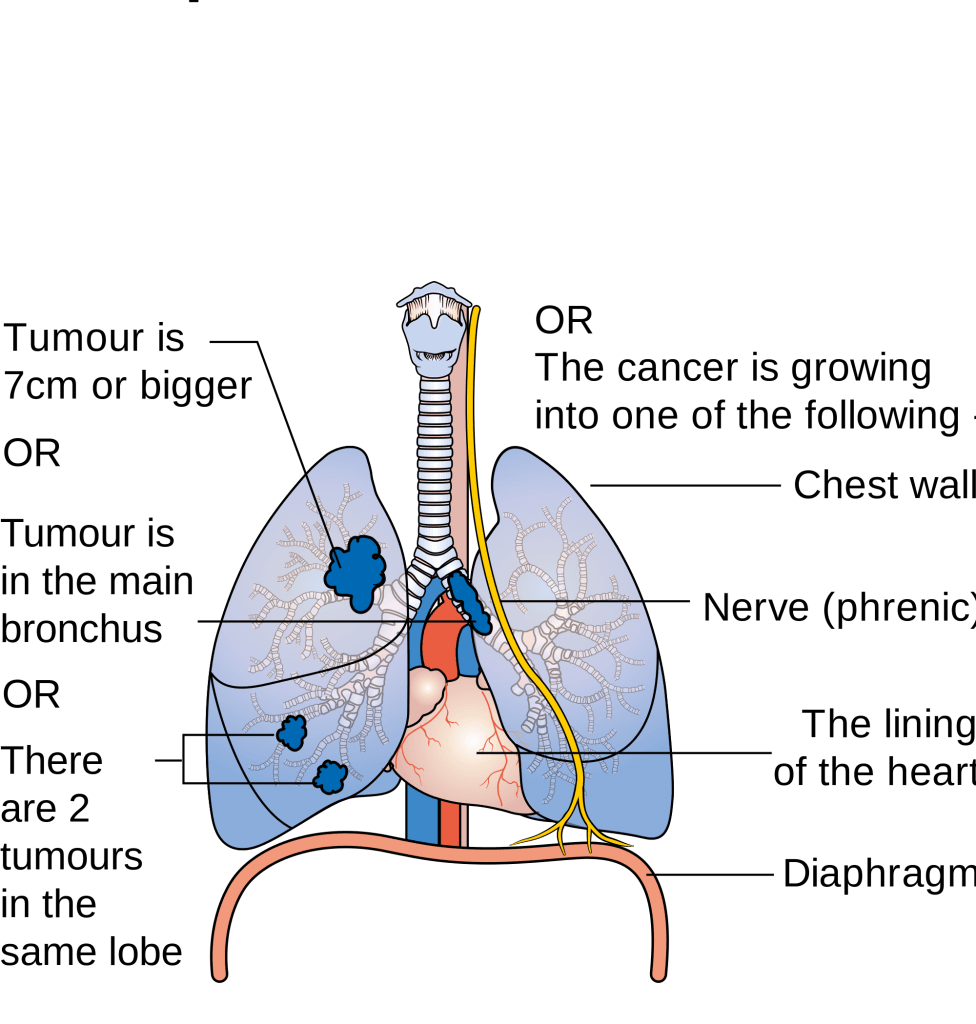 How do those with lung cancer present