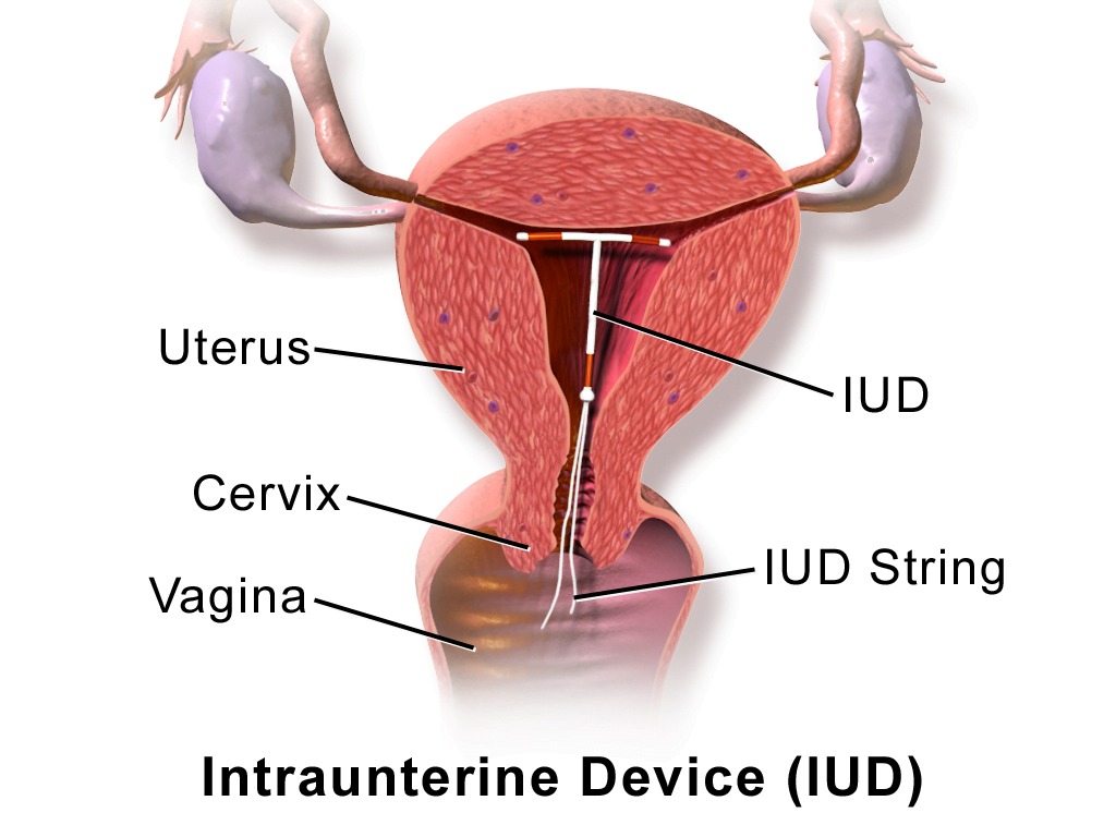 Intrauterine devices (IUD)