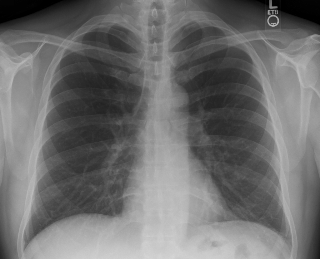 Chest Radiography (Chest X-Ray, CXR)