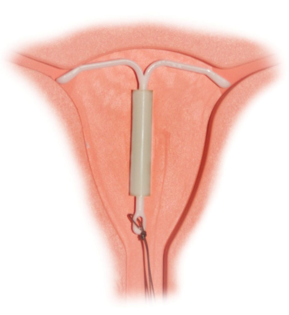 Who qualifies to really have the TCu380A IUD?